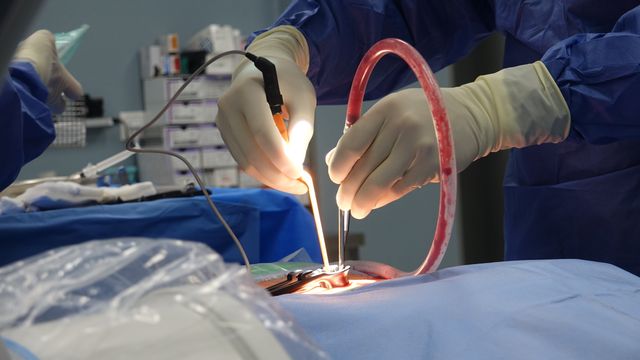 Stenting For May-Thurner Syndrome