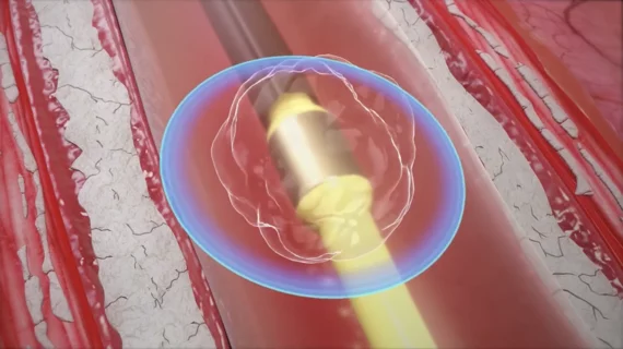 Coronary Atherectomy